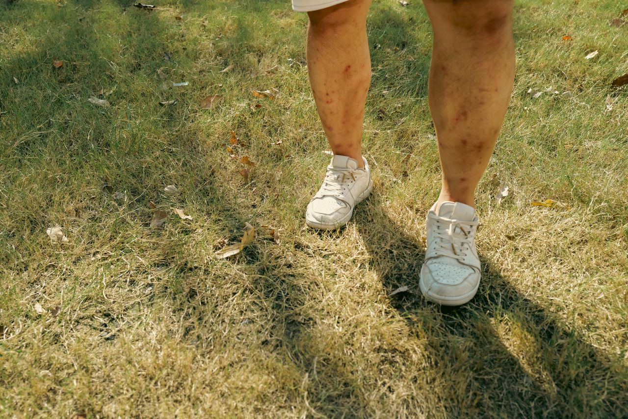 Venous Ulcer